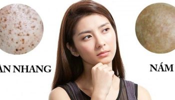 Cách Dưỡng Da Nám, Tàn Nhang Khôi Phục Làn Da Sáng Bóng